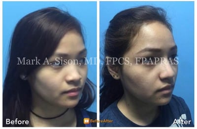 marksison-com-before-after-face-nose-surgery-2