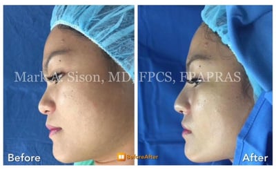 marksison-com-before-after-face-nose-surgery
