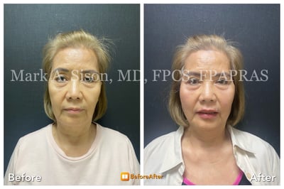 marksison-com-before-after-face-thread-lift