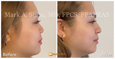 marksison-com-before-after-nose-2