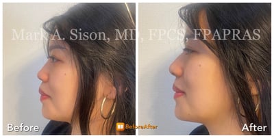 marksison-com-before-after-nose-3